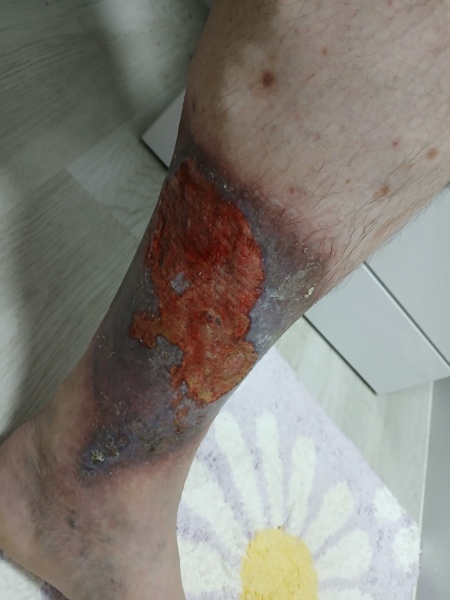 Husband leg infection being almost ignored (disgusting pics included)