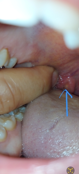 White/yellow spot and pus near tonsils (not tonsillitis)