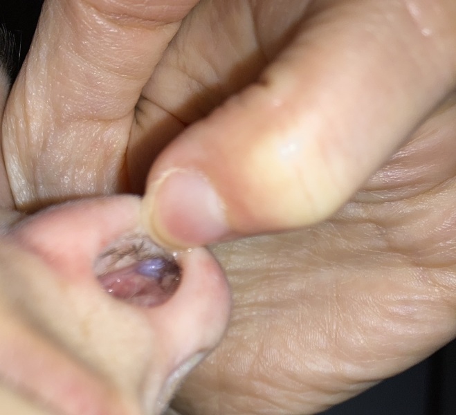 Strange lump inside my nose