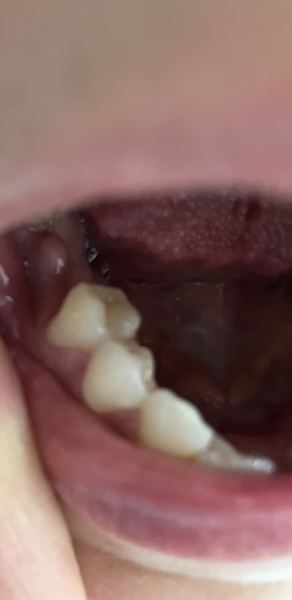 Dentists please help- is this an abscess?