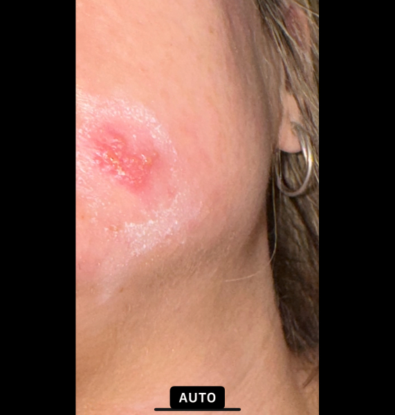 Impetigo or shingles?