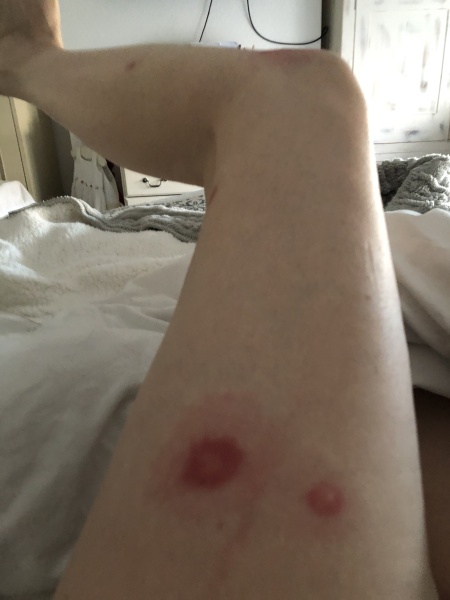 Infected mosquito bite?