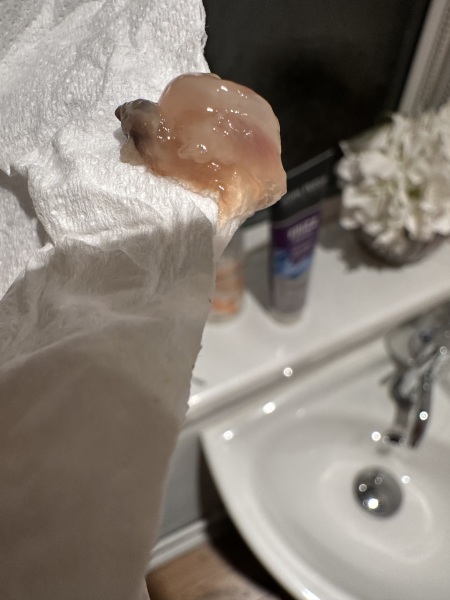 Pregnant , anxious , confused , early miscarriage 