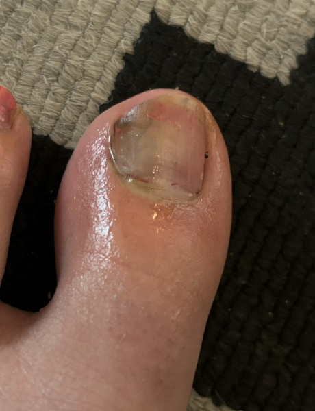 Infected toenail? PICTURE ALERT