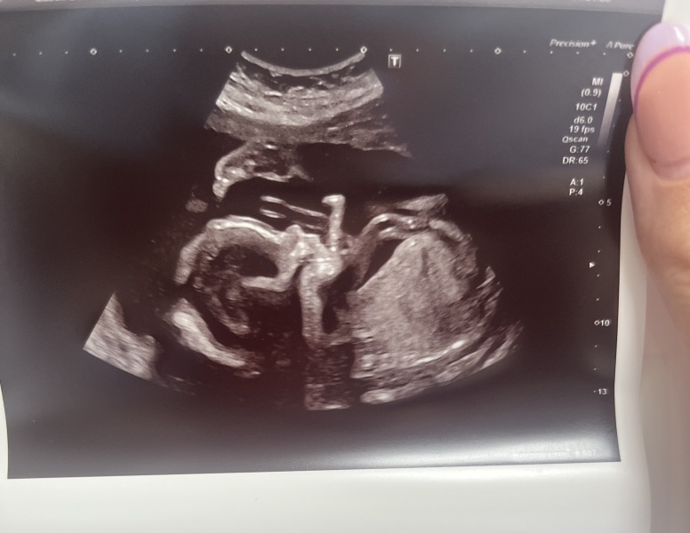BFP after IVF - the journey continues (part 2)