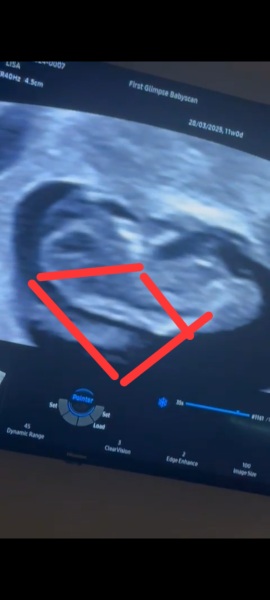 10 week scan, is this normal?