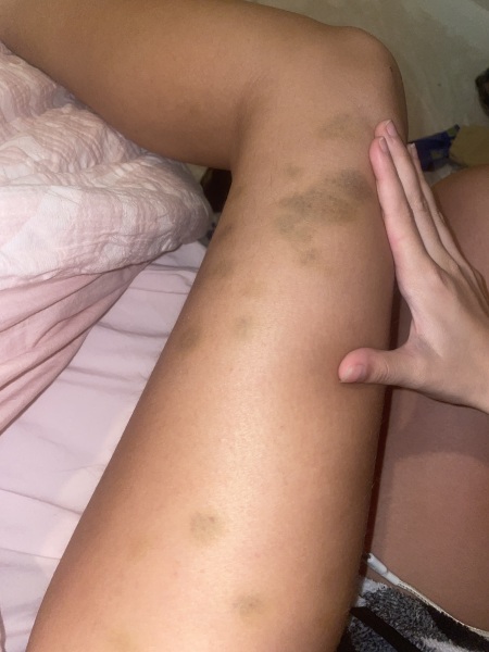 Bruising
