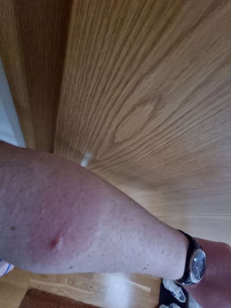 Weird Insect Bite