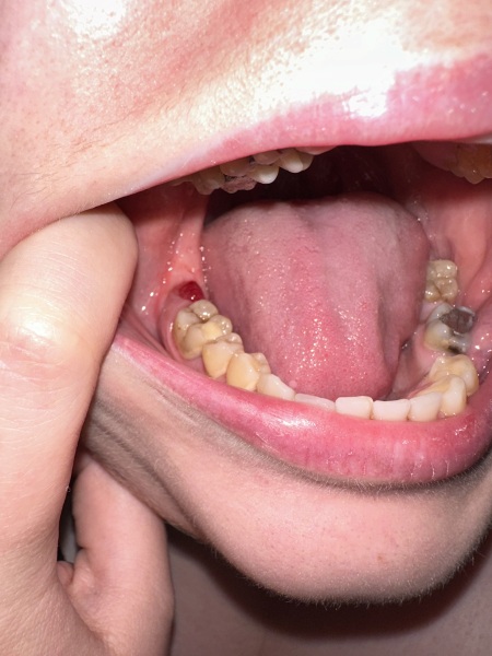 Is this normal, over three weeks past extraction. TW gross photo