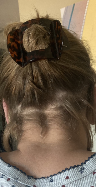 Is this Alopecia? Photo included
