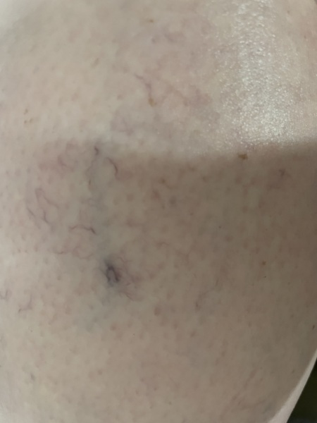 Varicose?