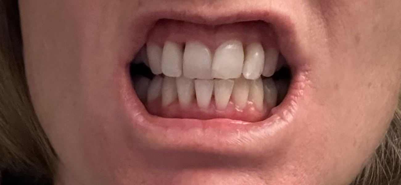 Awful gums (pic included)