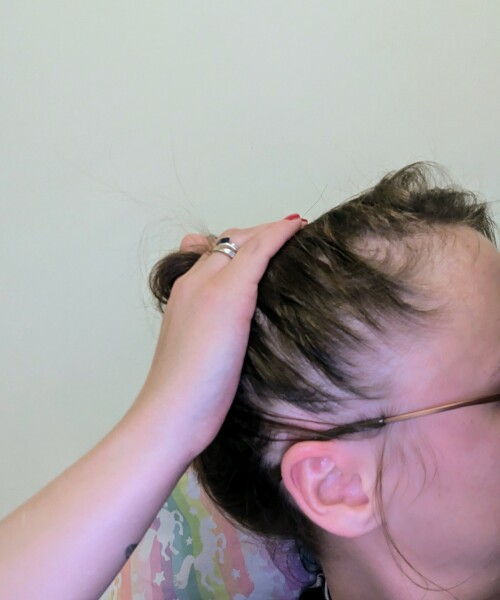 Hair falling out rapidly (photo) - causes?