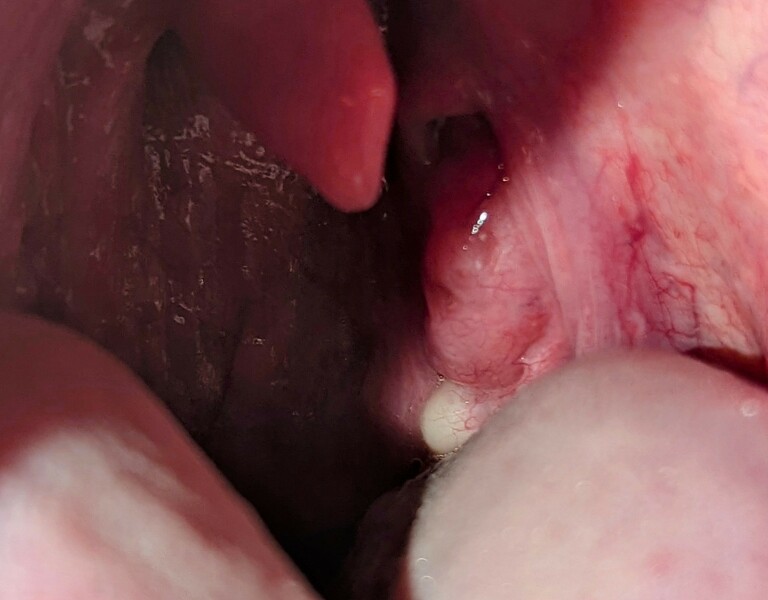 Potential tonsil cyst
