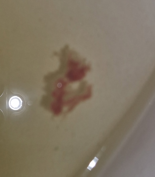 Red Tissue in Urine? Pic TMI