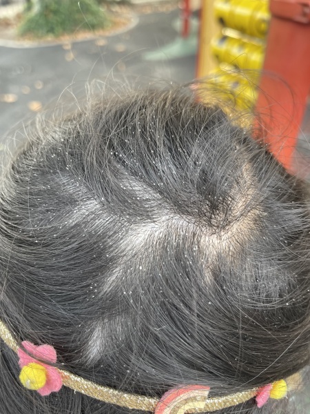 Dandruff or Nitts?