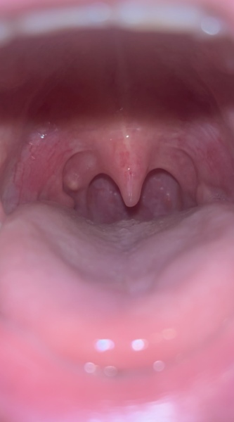 Potential tonsil cyst