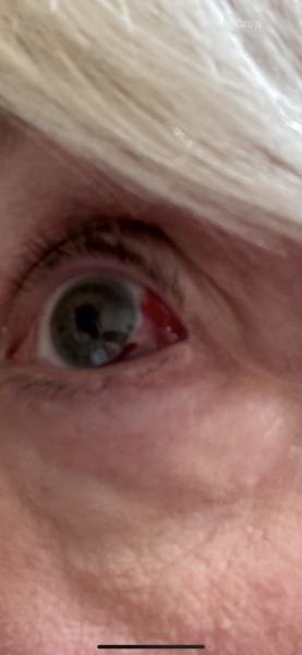 What is wrong with my eye? (Picture)