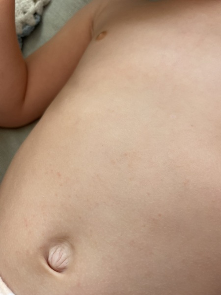 Daughters itchy palms for 2 weeks