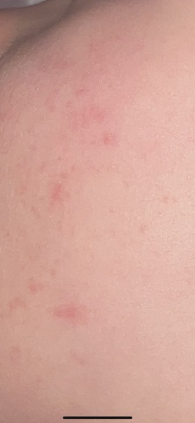 Rash - 1 year old?