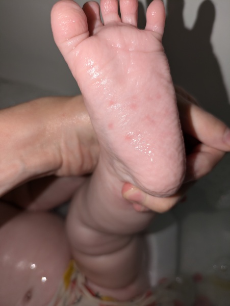Found these weird spots on daughters foot.