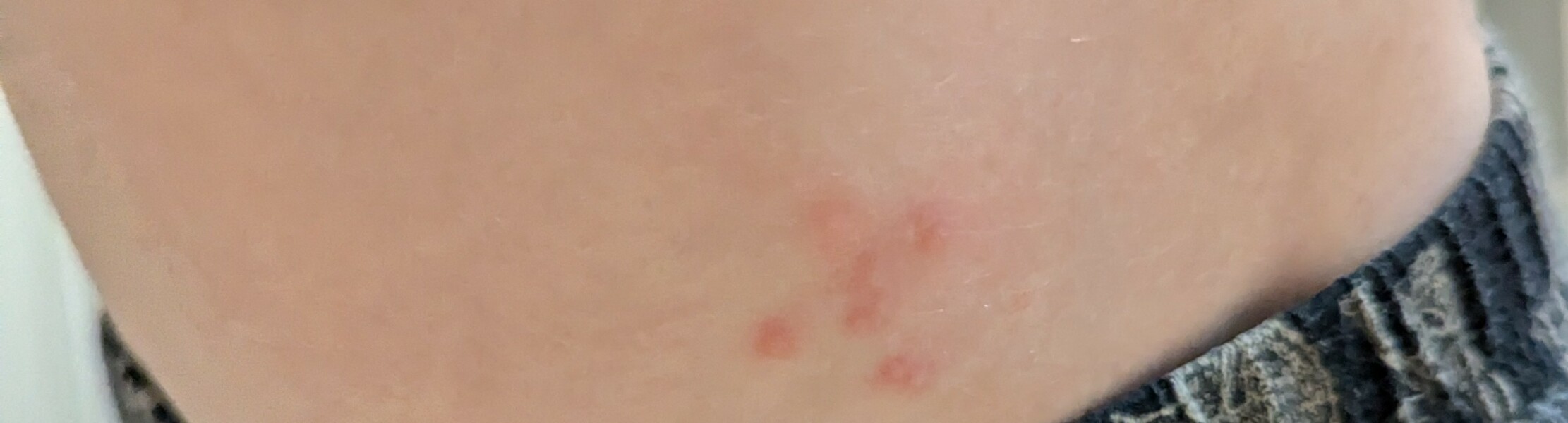 5 year old rash