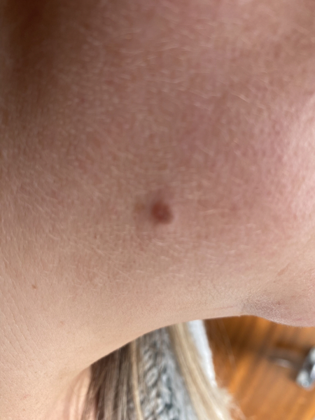 Mole/freckle with white spot on it. Please reassure me. No sinsiter comments please