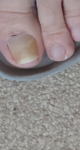 Toe nail fungus?