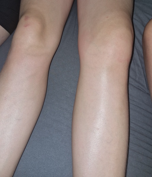 Swollen knee