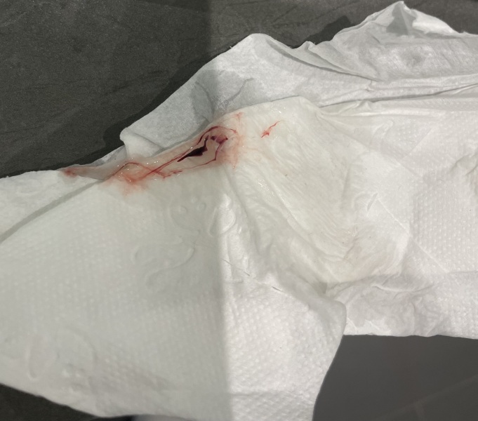 Implantation bleeding *graphic picture*