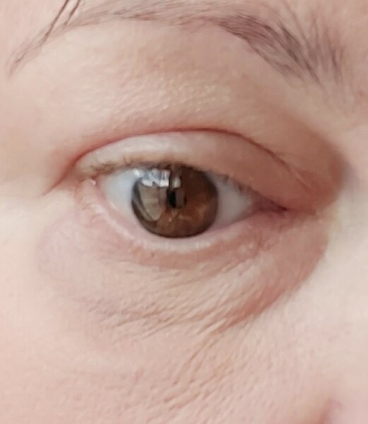 Is this blepharitis?