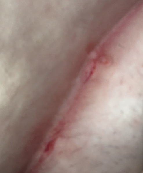 Skin under tummy splitting after ultrasound?