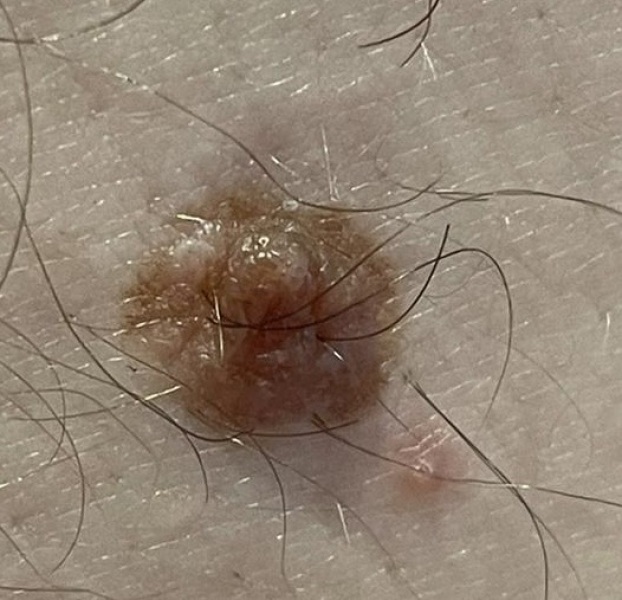 Dodgy mole - skin cancer?