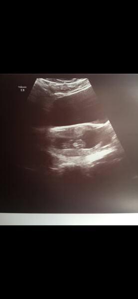 Abdominal scan with tilted uterus