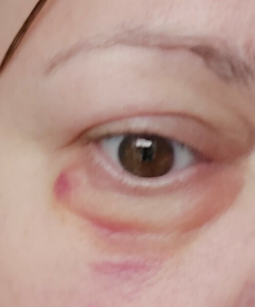 Is this blepharitis?