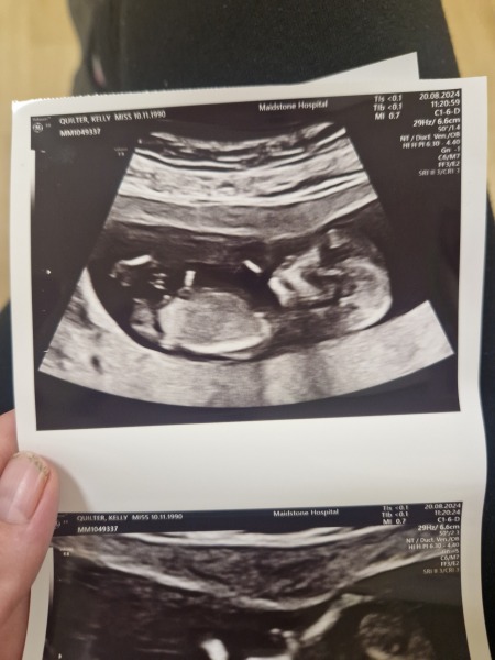 Scan what do u think boy or girl