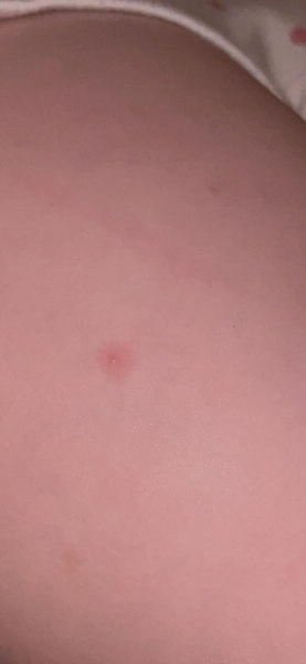 Could this be chicken pox?