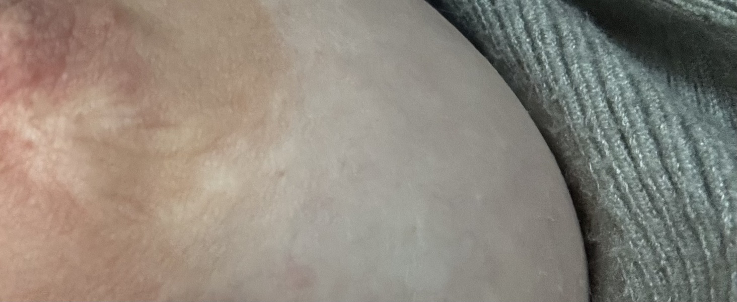 Please help. Is this breast dimpling ??