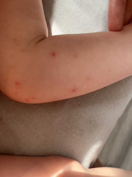 Hand Foot and mouth or chicken pox??