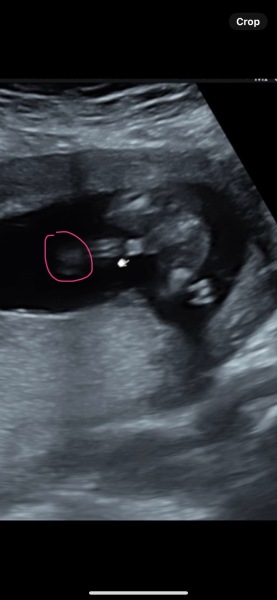 16 week scan