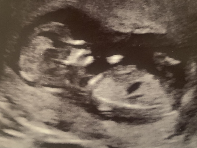 Thoughts on Gender using Nub/Skull theory