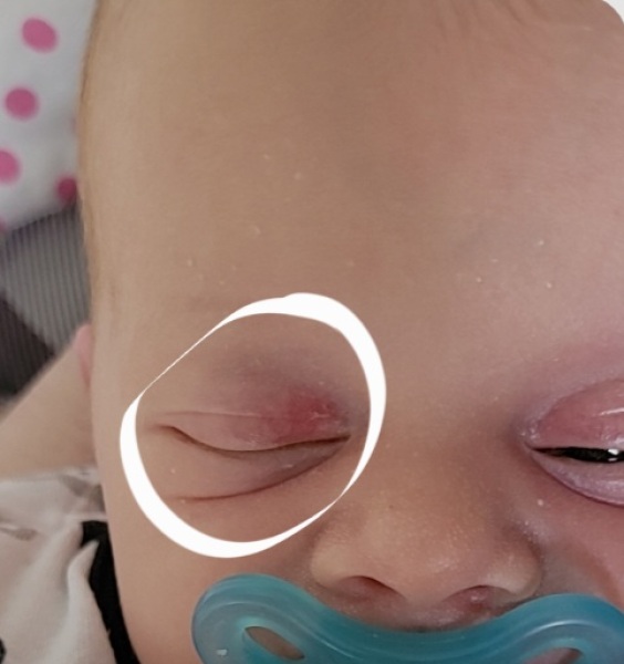 What is this mark on babys eye?