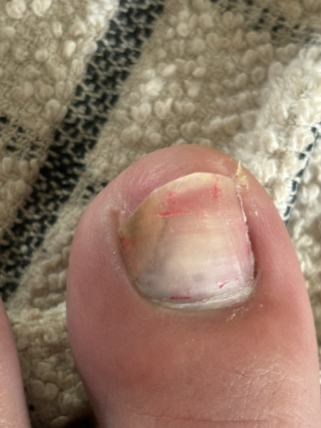 Infected toenail? PICTURE ALERT