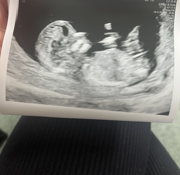 Boy or girl from scan picture?