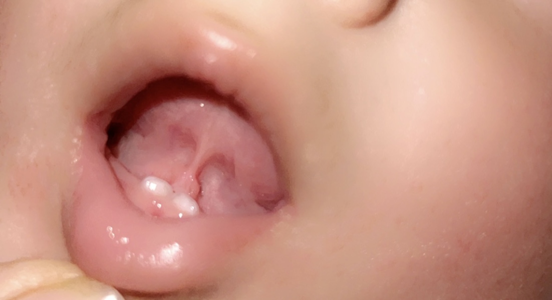 Tongue tie?