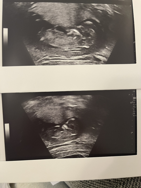 BFP after IVF - the journey continues (part 2)