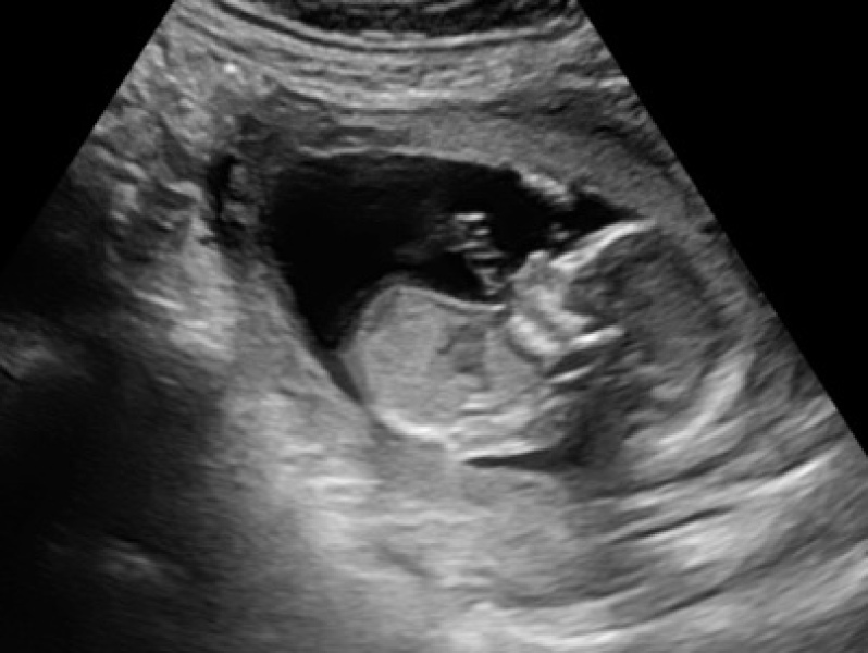 16 week gender scan
