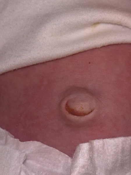 Does this umbilical cord look infected? IMAGE INCLUDED