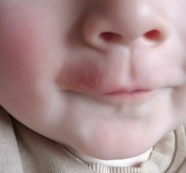Baby eczema recommendations!
