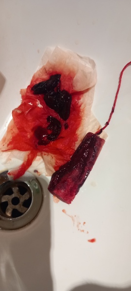 Really heavy period *** Gross photo warning***